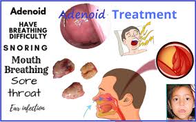 They are also usually triggered by chronic inflammation and are associated with a number of health conditions. Adenoid Homeopathic Treatment Nasal Polyp