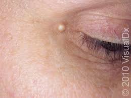 Image result for milium cyst on eyelid