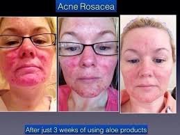 frances griffiths mrsgriffiths13 forever living aloe vera forever aloe rosacea
