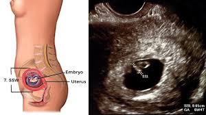 Ich bitte die frauen, nach der ultraschall. Entwicklung Embryo Fotus Grossen Tabelle Bilder Hallo Eltern