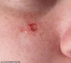 A new patch that looks like a scar. Woman 32 Develops Skin Cancer From A Chickenpox Scar Which Was 27 Years Old Internewscast