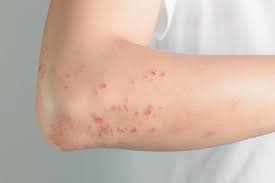 Maybe you would like to learn more about one of these? Ciri Ciri Penyakit Kulit Yang Gampang Dikenali Anda