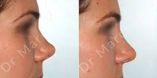Nettoyer son nez apres rhinoplastie : Rhinoplastie De Diminution A Paris Dr A Marchac Chirurgie Esthetique