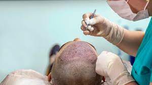On the upside, i did get a nice bob cut out of the deal! Fue Hair Transplant What To Expect Cost Pictures And More