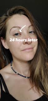 Recovery from eye surgery with pet support