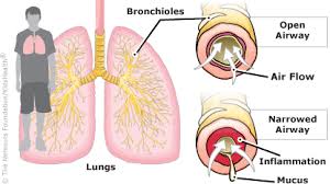Frying your nuts with radiation would be painful! Asthma For Parents Nemours Kidshealth