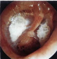 Image result for Myringosclerosis