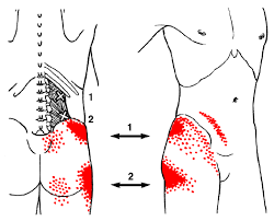 47 Prototypic Travell Trigger Point Chart