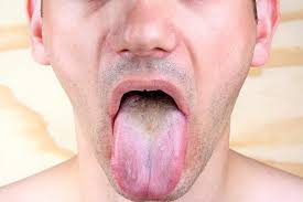 Image result for brown tongue symptoms