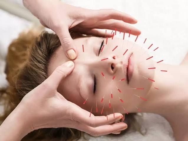 Cosmetic Acupuncture Brisbane - Facial, Anti Aging | AcuNatural Health