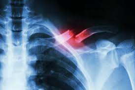 The basic idea of backbone is to organize your interface into logical views, backed by models, each of which can be updated independently when the model changes, without having to redraw the page. The Broken Clavicle Or Collar Bone Four Myths You Need To Understand Howard J Luks Md