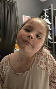 BREAKING NEWS‼️ Local kid tries to fake a case of chickenpox to skip  school. Sources say the red sharpie gave her away. 🫣🥴
