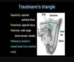 Removal of mastoid and petrous bone reveals the bony labyrinth and the posterior, superior, and lateral semicircular canals. Lets Revise Trautmann S Rajiv Dhawan Ent Discussion Facebook