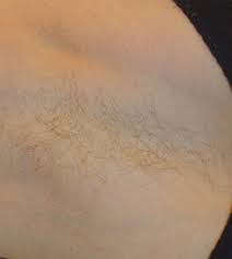 Jayk body salon for men. Geelong Permanent Hair Removal Before After Photos