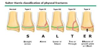 Image result for Fracture Type