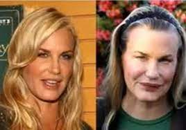 Check out plastic surgery gone wrong with before and after photos of bad celebrity plastic surgeries at womansday.com. 17 Celebrity Before And After Plastic Surgery Disasters