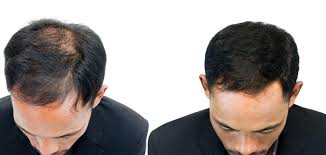 Giovanile è affetta da calvizie più o meno gravi già a partire tra i 12 e i 20 anni. Tricologia Milano Bologna Modena Rimini E Brescia Check Up Gratis