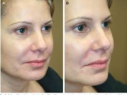 Figure 5 from Midface volumization with injectable fillers.