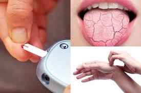 Pengkongsian umum berkaitan diabetes atau di kenali kencing manis. Tidak Hanya Kencing Lebih Sering Mulut Kering Dan Kulit Gatal Bisa Jadi Tanda Awal Dan Gejala Diabetes Semua Halaman Intisari