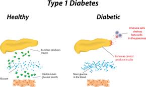 In patients diagnosed with diabetes mellitus (dm), the therapeutic focus is on preventing complications caused by hyperglycemia. Diabetes Mellitus Type 1 Pathophysiology Wikidoc