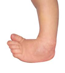 Image result for Pediatric Leg Disorder