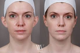 ✨Otoplasty Transformation ✨ Otoplasty is an ear surgery to pin back  prominent ears. The beauty in this surgery lies in its ability to draw  attention back to the face. While there's no