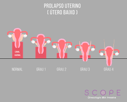 Prolapso Uterino Conheca Causas E Tratamentos Scope