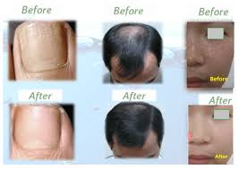 Moreover, it is also known that silica helps in keeping the skin elastic, aids in restoring the natural skin glow, and also prevents cellulite and strengthens the nails. Silica Deficiency Or Impaired Silica Metabolism Can Lead To A Variety Of Diseases Silica Ansu Silica Ansu Wellness