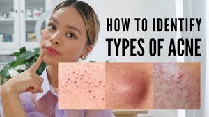 Check spelling or type a new query. Types Of Acne How To Identify And Treatment Banish