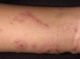 Dermatite De Contato Disturbios Dermatologicos Manuais Msd Edicao Para Profissionais