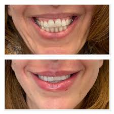 How to fix a crooked smile with botox. A Little Lip Filler And Gummy Smile Botox Plasticsurgery