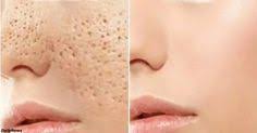 как сделать лицо чистым и гладким в домашних условиях Pory Na Lice Ischeznut Cherez 3 Dnya Esli Delat Vot Eto Lico Sredstva Dlya Kozhi Chistoe Lico