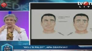 Mengenal cerebral palsy, penyakit pada anak yang efeknya sampai dewasa. Perlu Tahu Terapi Menyembuhkan Bell S Palsy