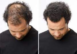 These properties alone make ricinoleic acid and, therefore, castor oil, a treatment option to be considered by those with alopecia. The Magic Homemade Recipe For Fastest Hair Growth 3 Ingredients Only Hair Loss Remedies Hair Remedies For Growth Hair Growth Faster