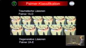 Arthroskopie auch die arthroskopie ist kein standarddiagnostikum Lasionen Des Tfc Komplexes Am Handgelenk Youtube