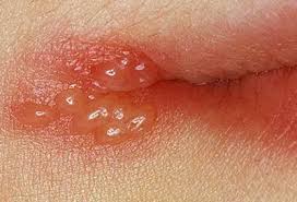 Image result for oral herpes symptoms roof of the mouth
