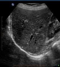 Starry Sky Appearance Ultrasound Radiology Reference Article Radiopaedia Org
