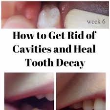 How To Get Rid Of Cavities And Heal Tooth Decay Tooth Decay Teeth Health Cavities