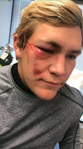 Importance of wearing helmets while skiing safely