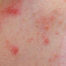 Cancerul cavitatii bucale sau cancerul oral poate sa apara la nivelul buzelor, limbii, gurii, gingiilor, obrajilor, partii superioare a gatului sau orofaringelui. IritaÅ£ia Organelor Genitale Cauze Simptome Si Tratament