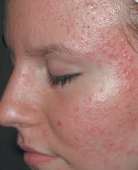 Acne and Rosacea: Epidemiology, Diagnosis and Treatment