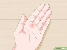 Also, they often conduct bible studies with members of the deaf community who are not witnesses. 4 Ways To Heal Blisters Wikihow
