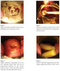 Escharotic Treatment For Ecc Positive Cin3 In Childbearing Years A Case Report Abstract Europe Pmc