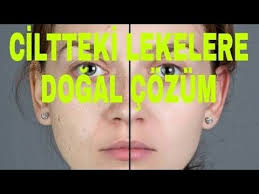 3 Uygulamada Lekeleri Gideren Maske Sadece 3 Uygulamada Sonuc Alacaginiz Lekelerinizden Sizi Kurtaracak Olan M Cilt Bakimi Tuyolari Cilt Beyazlatma Cilt Bakimi
