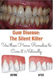 Top Remedies And Tips For Good Gum Care Gum Disease Remedies Gum Care Gum Health