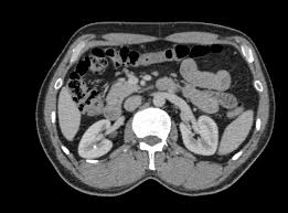 Image result for Nephrolithiasis Imaging