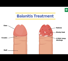 Image result for Balanitis