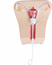 On a scale of 10, the pain was a 10. Iud Insertion Model I