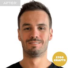 Female Hair Transplant NYC by Nova Medical Hair Transplant