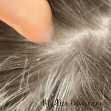 Check spelling or type a new query. Lice Vs Dandruff 7 Key Differences Between Lice Eggs And Dandruff